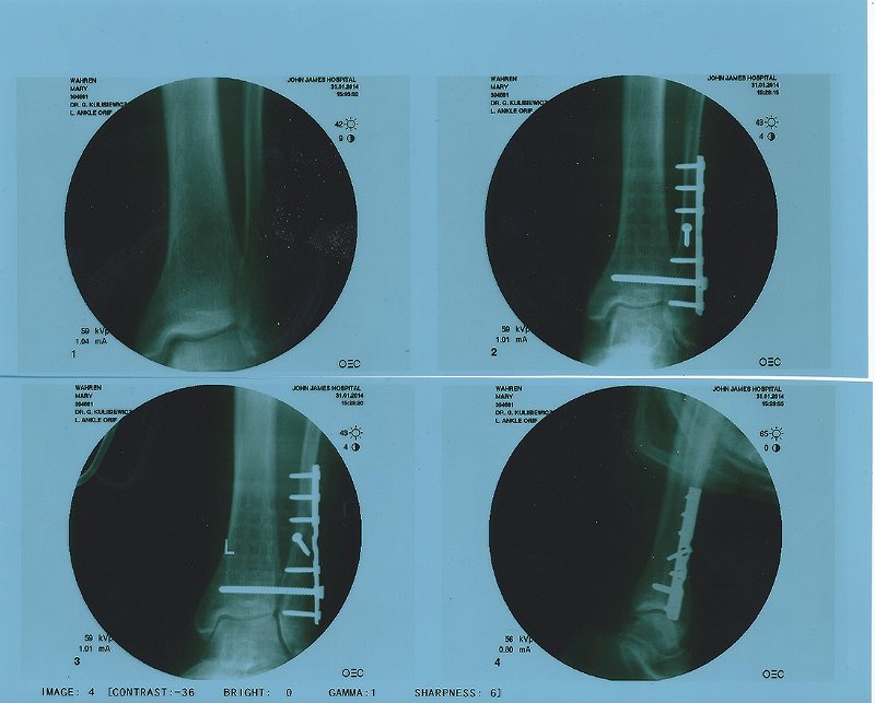 mary-s leg.jpg